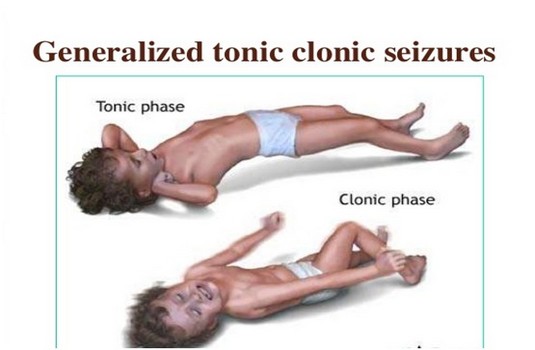 Generalized Tonic Clonic Seizures Epilepsy Treatment In India Cost Hospitals Doctor